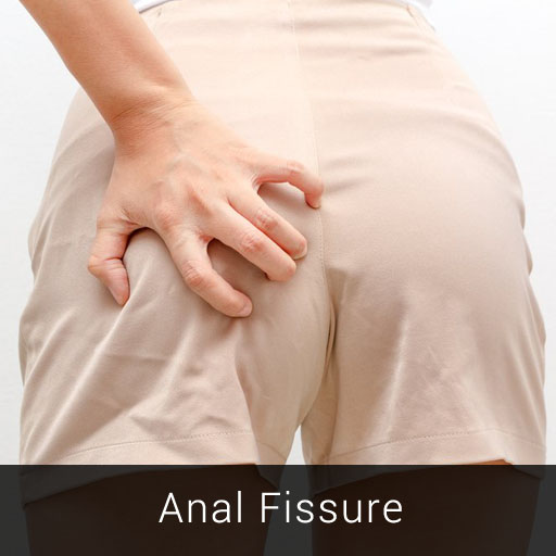 Anal Fissure