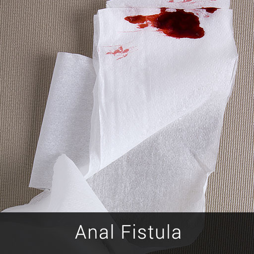 Anal Fistula