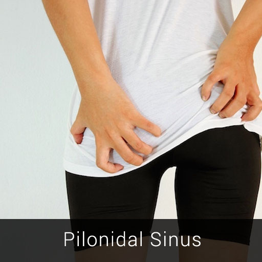 Pilonidal Sinus