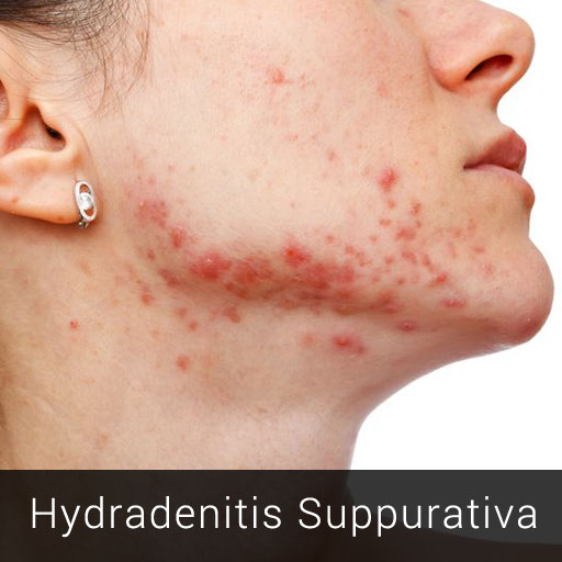 Hydradenitis Suppurativa