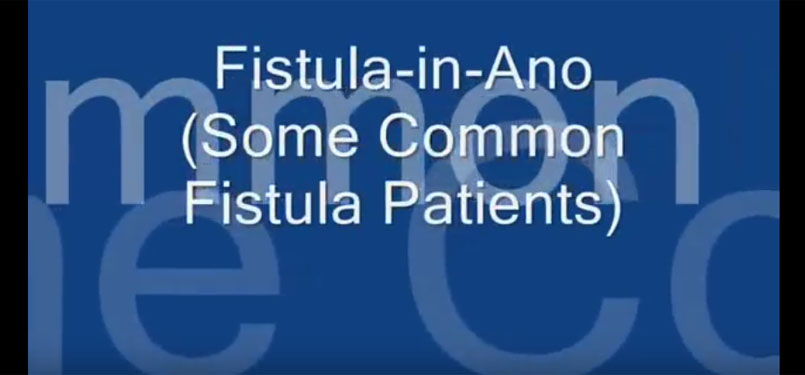 Common types of fistula